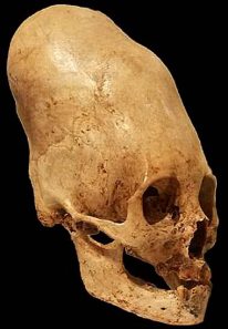 Cráneo en forma de cono de Paracas-Perú